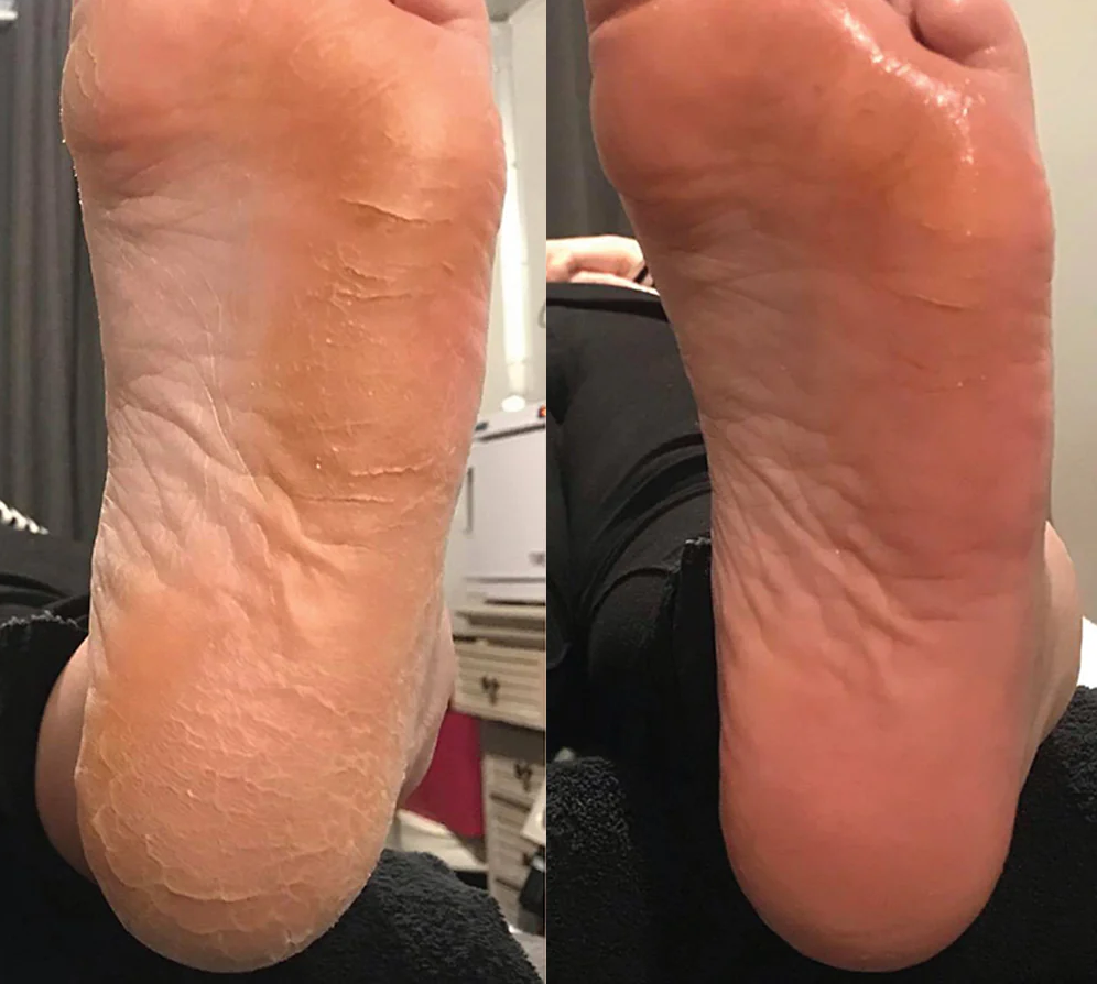 SilkPro – Salonkwaliteit Voetverzorging voor Thuis