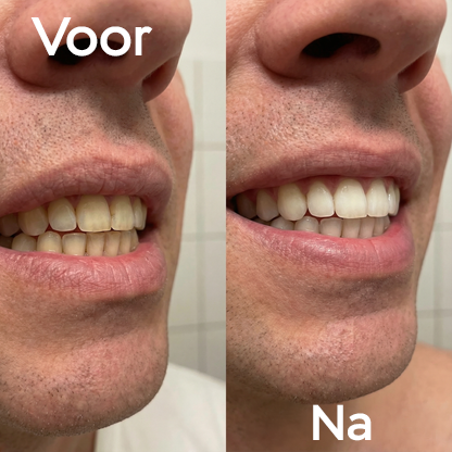 Paarse Whitening Strips