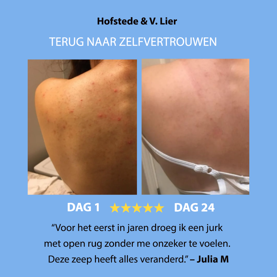 Anti-Acne Soap
