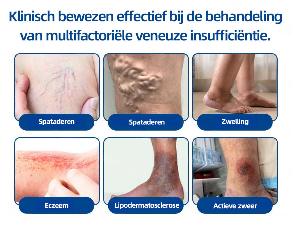 Florisma® – Zichtbaar minder spataderen in enkele weken