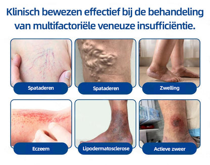 Florisma® – Zichtbaar minder spataderen in enkele weken