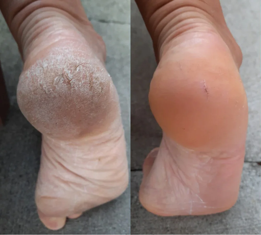 SilkPro – Salonkwaliteit Voetverzorging voor Thuis