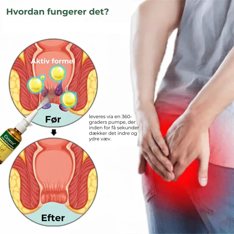 Miréa Relief Spray ™ – Snelwerkende Spray tegen Aambeien