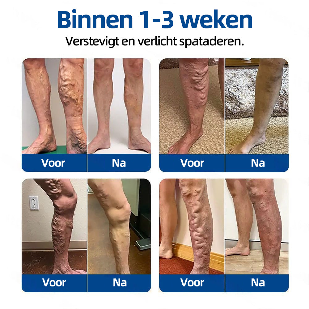 Florisma® – Zichtbaar minder spataderen in enkele weken