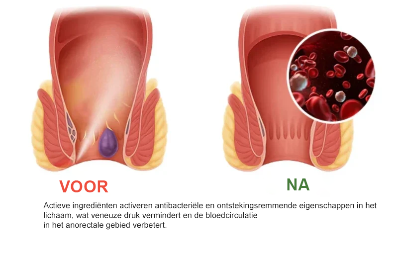 Miréa Relief Spray ™ – Snelwerkende Spray tegen Aambeien