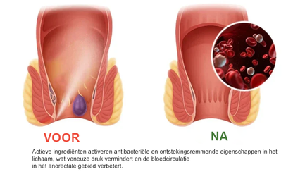 Miréa Relief Spray ™ – Snelwerkende Spray tegen Aambeien