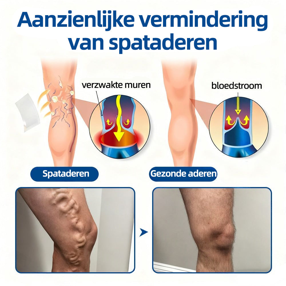 Florisma® – Zichtbaar minder spataderen in enkele weken