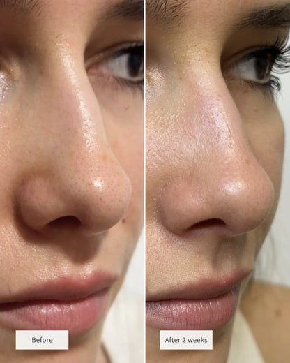 ClearSkin™ Nose Patches