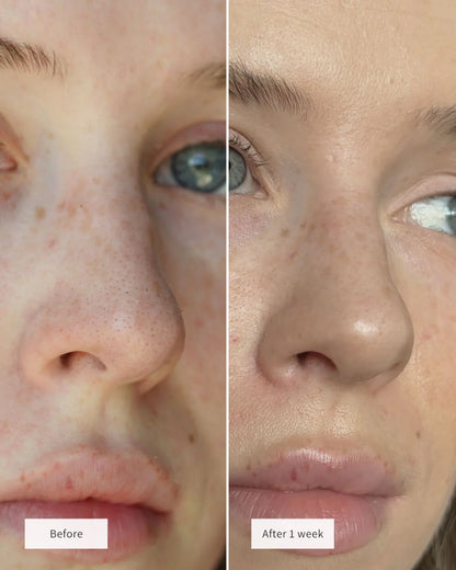 ClearSkin™ Nose Patches