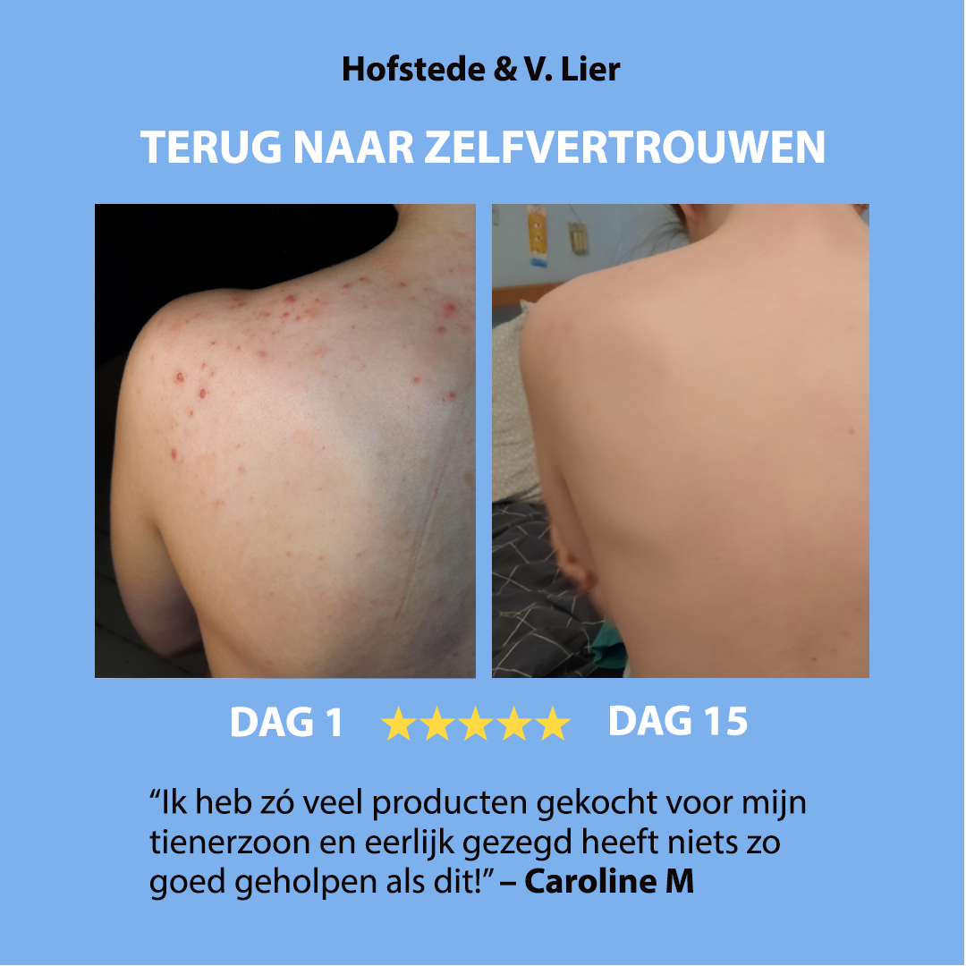 Anti-Acne  Soap