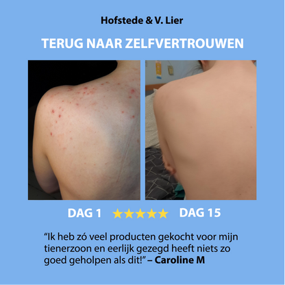 Anti-Acne  Soap