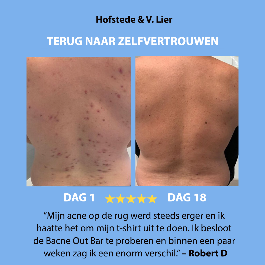 Anti-Acne  Soap