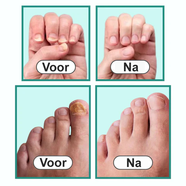 "OrthoVital" Doodt nagelschimmel in 7 minuten.