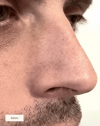 ClearSkin™ Nose Patches