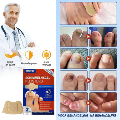FUSTOP™ Schimmelnagelpleisters