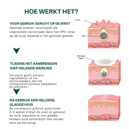 Hofstede ® Magnesium MicroPin HPV Genitale Wrat Verwijdering Patch