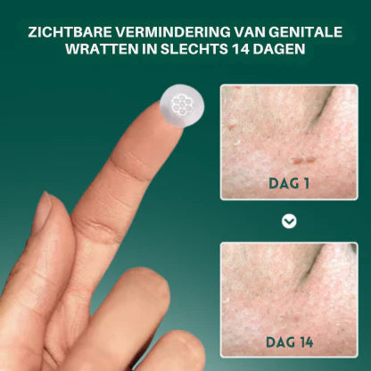 Hofstede ® Magnesium MicroPin HPV Genitale Wrat Verwijdering Patch